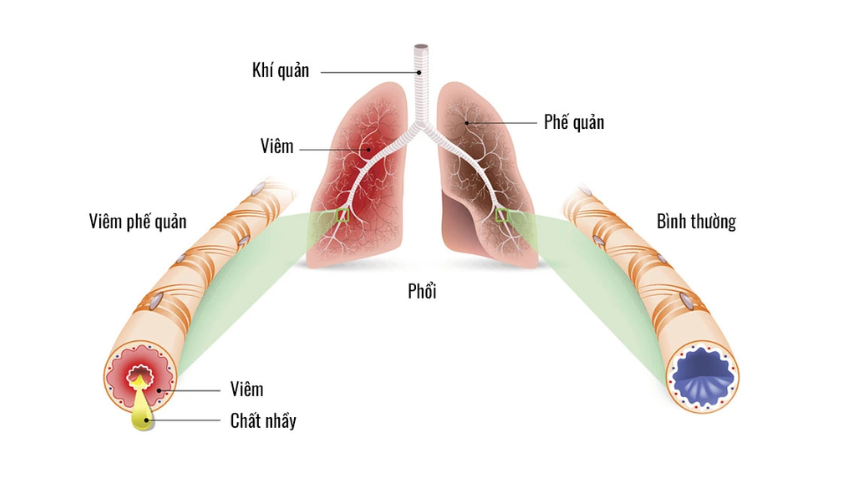 Những triệu chứng viêm phế quản cấp cần lưu ý